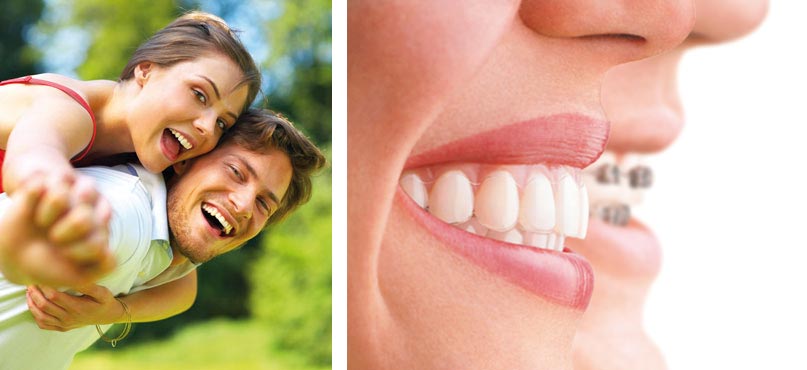 Aligner-System - Unsichtbare Behandlungsmethode
